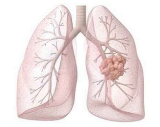 肺癌的早期诊断