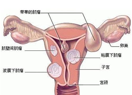 子宫肌瘤是怎么引起的？