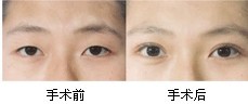 韩式双眼皮对比照片