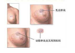 乳腺癌晚期症状图